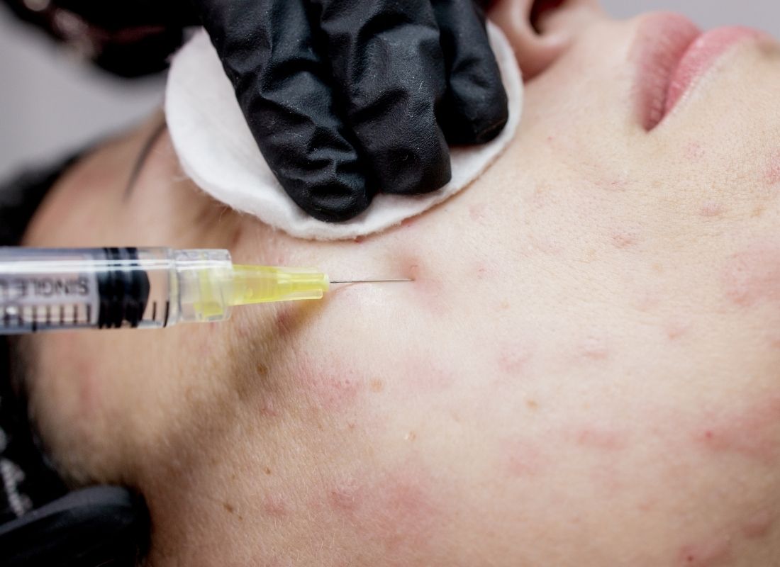 Mezoterapia igłowa w Gdańsku – skuteczny sposób na poprawę kondycji skóry